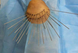 银质针视频,揭秘古老针法的现代应用与疗效